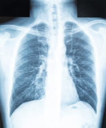 Belly Breathing for Stress Relief. xray of the lungs  and the Three Chambers of Breathing
